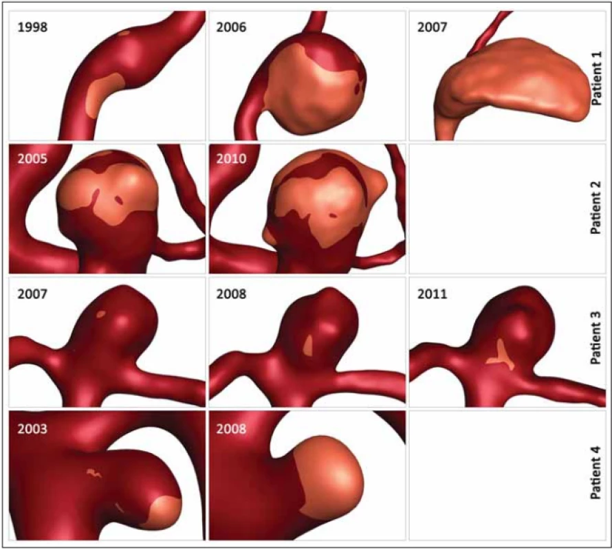Images of proportional layout of low wall shear stress area. Overview of the space enlargement of the low wall shear stress area
in four aneurysm during their follow-up period.<br>
Obr. 1. Proporční rozložení oblasti s nízkým smykových napětím. Přehled zvětšování oblasti s nízkým smykovým napětím ve čtyřech
aneurysmatech během sledování.
