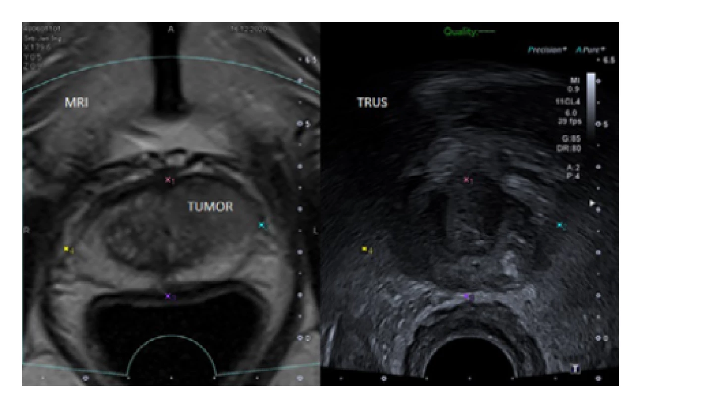 MRI/TRUS fúzní zobrazení prostaty s ložiskem
charakteru PIRADS 5 v levém laloku ventrálně vhodném
k TPBxP (archiv autora)<br>
Fig. 6. MRI/TRUS fusion images of the prostate with
a PIRADS 5 lesion in the anterior part of the left lobe
sutable for TPBxP (author’s archive)