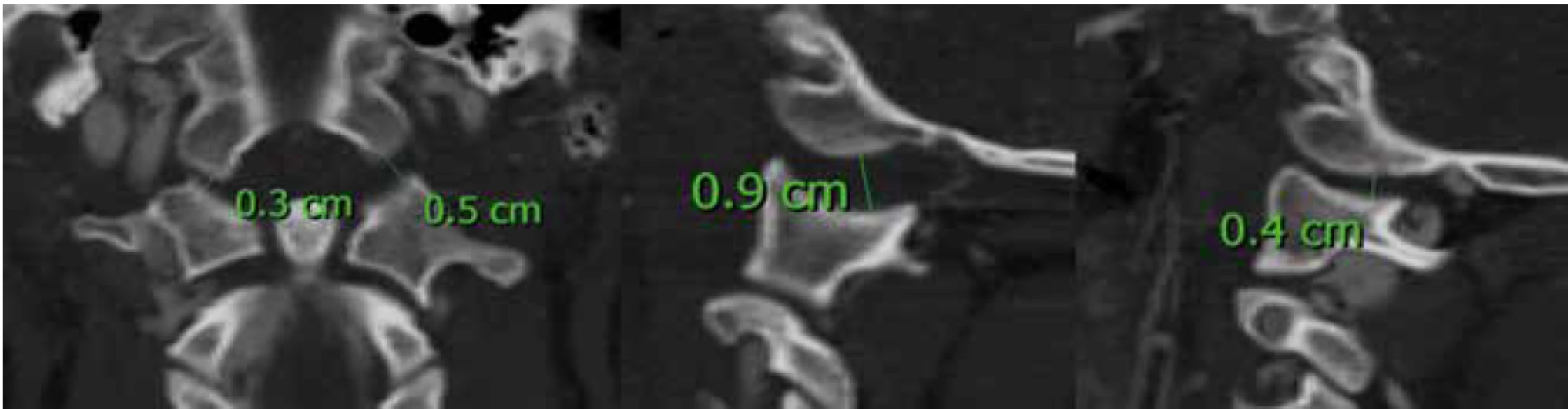 CT vyšetření prokazující AOD s využitím měření kondyl-C1 intervalu (CCI)<br>
Fig. 3. CT examination showing AOD using the condyle-C1 interval (CCI) measurement
