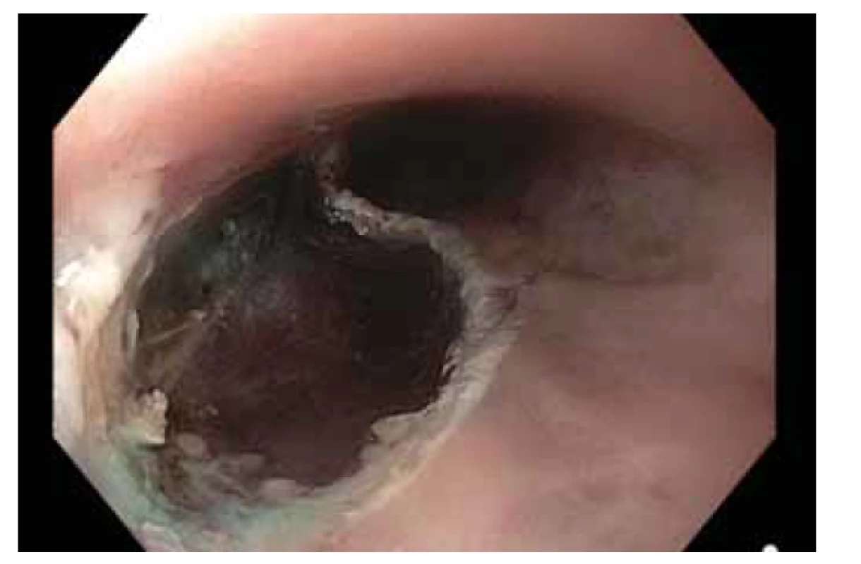 Spodina po provedení liftingu a EMR léze způsobem
„suck and cut“.<br>
Fig. 4. The bottom after lifting and EMR lesions in a “suck and
cut” manner.