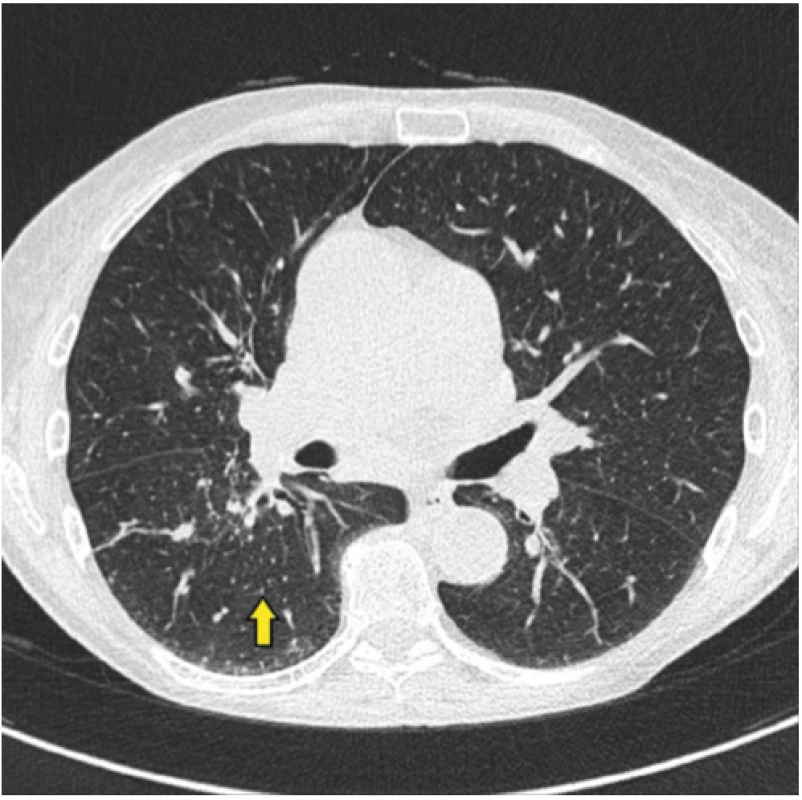 Radiologický obraz onemocnění – kazuistika 1
