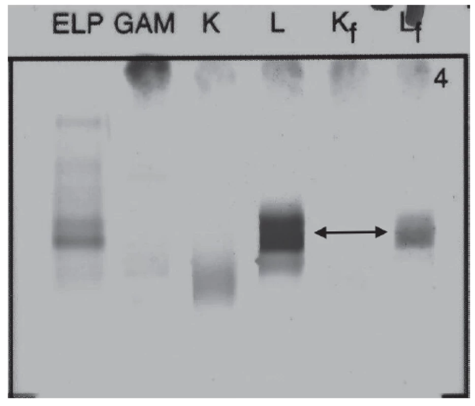 Immunofixation electrophoresis of patient´s urine sample
presenting Lambda Bence-Jones protein.