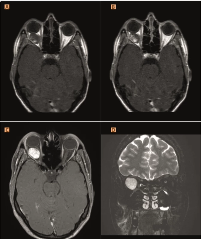  Cavernous haemangioma: (A, B) progressive saturation in dynamic study, (C) saturated tumour in T1STIR, (D) hypersignal well bordered intraconal formation in T2STIR
