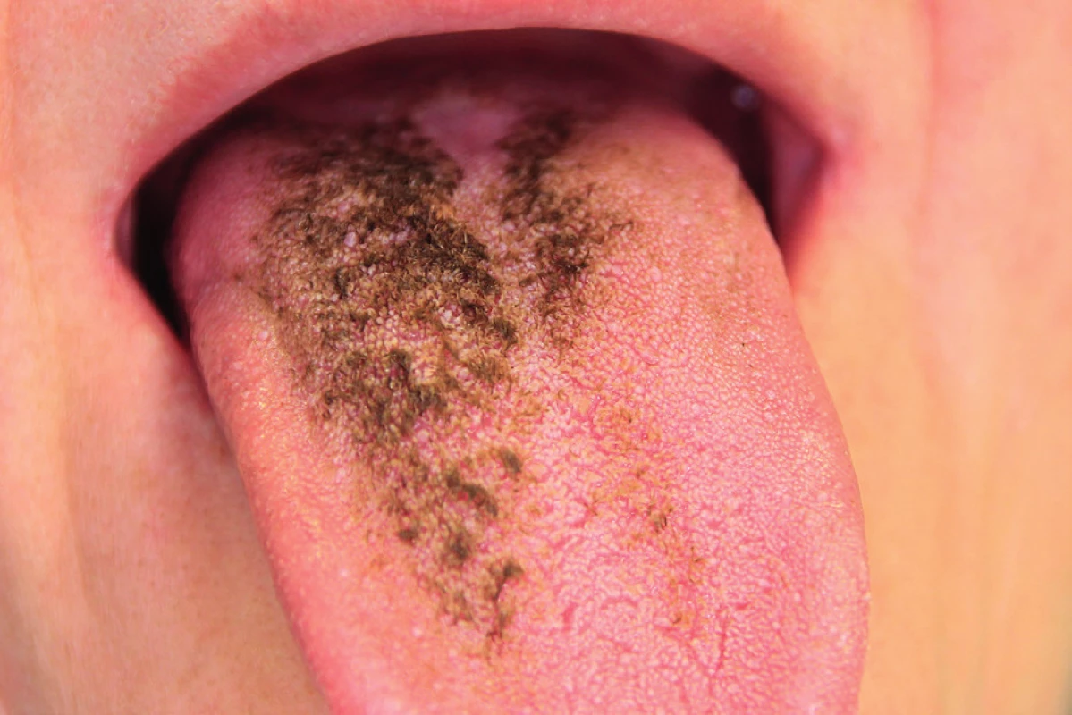 Lingua villosa nigra