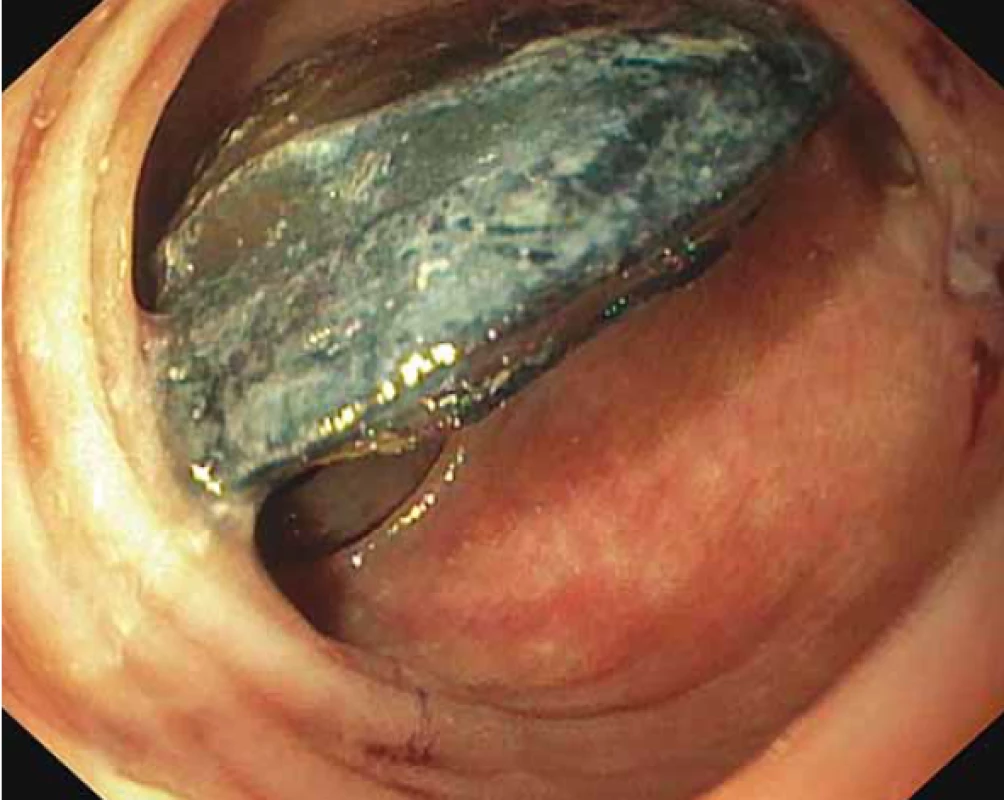 Objemný biliární konkrement sigmoidea.<br>
Fig. 1. Huge biliary stone of sigmoid.