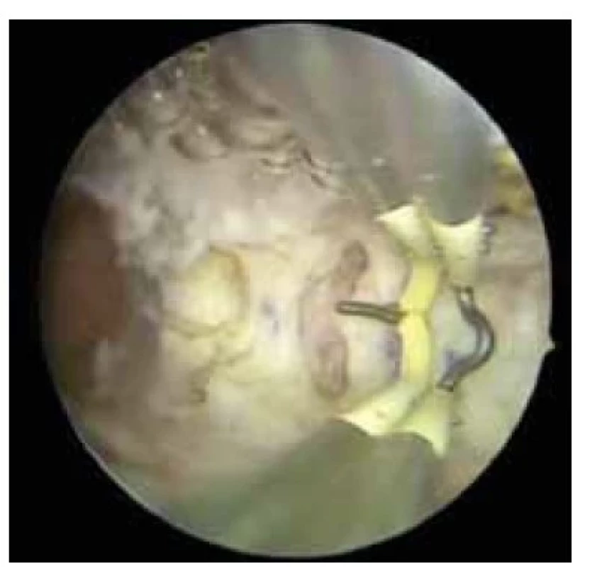 Hysteroskopická adheziolýza
středně těžkých adhezí.<br>
Fig. 2. Hysteroscopic adhesiolysis of
moderate adhesions.