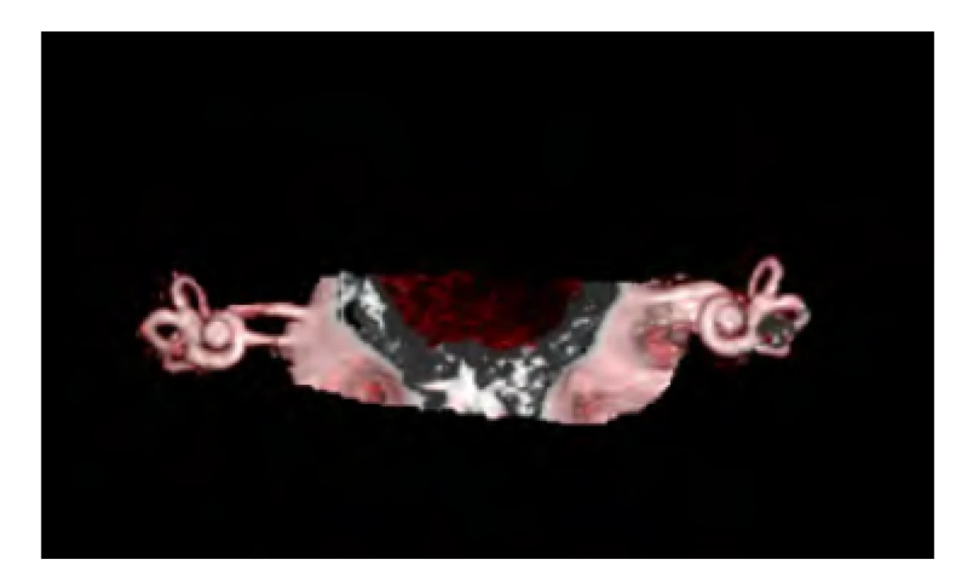 Septum vnitřního zvukovodu