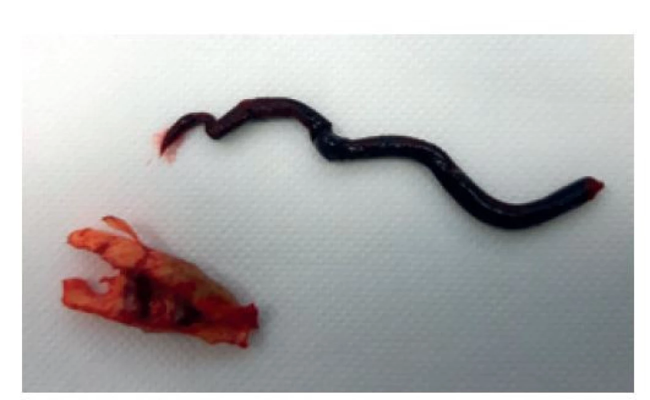Aterosklerotický plát s čerstvým trombem<br>
Fig. 3: Atherosclerotic plaque with fresh thrombus