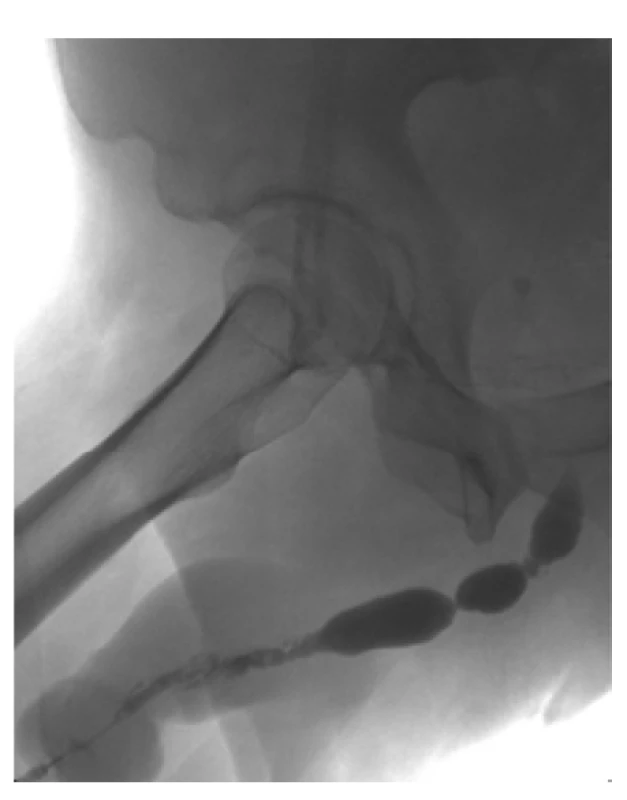 UCG prokazující panstrikturu uretry<br>
Fig. 1. UCG demonstrating panurethral stricture