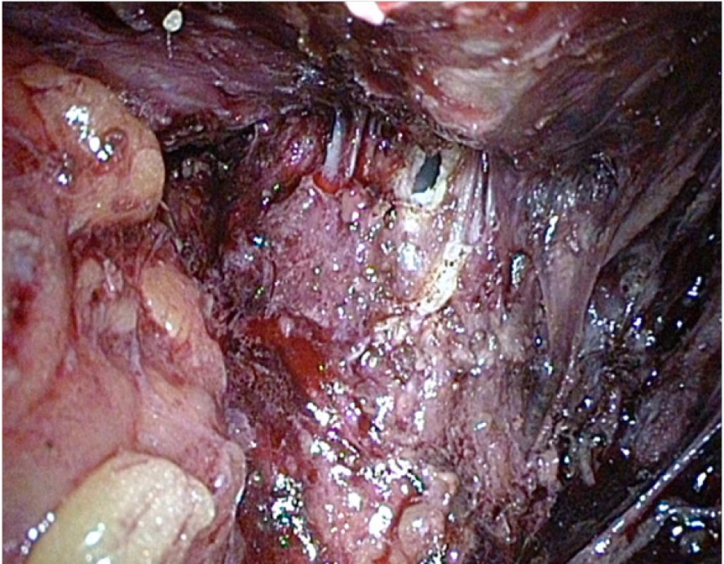 Peroperační léze rekta po apikální disekci
prostaty<br>
Fig. 2. Peroperative rectal lesion after apical dissection
of the prostate