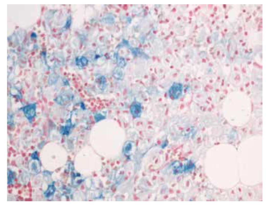 Histochemické barvení na železo (Fe) s pozitivitou gaucherových
buněk (zvětšení 200x).