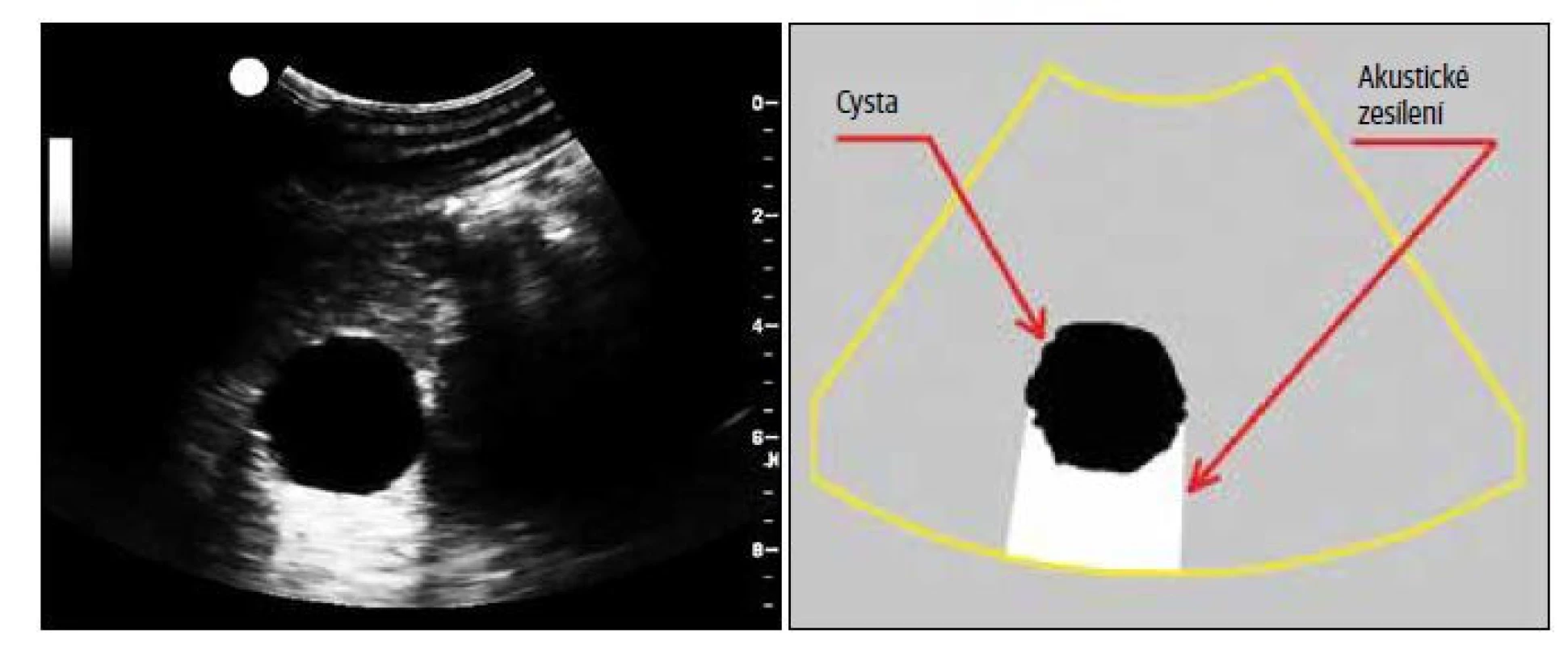 Dorzální akustické zesílení za cystou. Na obrázku můžeme rovněž vidět okrajové stíny;<br>
a) sonografický snímek, b) kresba.