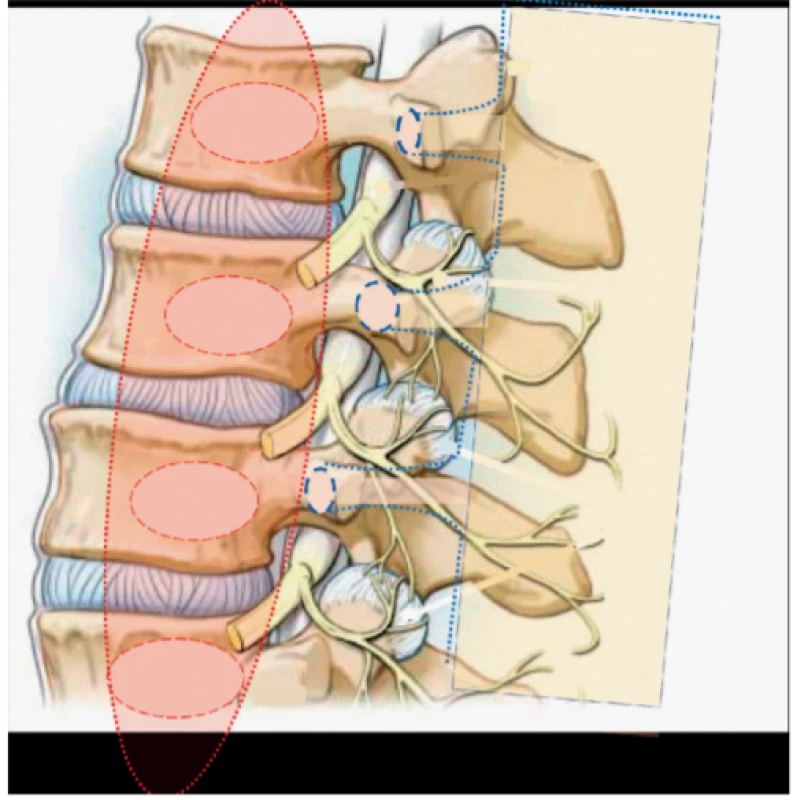 Do anatomického obrazu bederní páteře je schematicky vsazen
m. psoas major (PM) (červená barva), úpony na obratlová těla označena
červenou elipsou, úpony m. quadratus lumborum (QL) naznačeny modrou
elipsou a poloha svalu žlutou průsvitnou barvou a modrým okrajem. Přední
větve Th12 a L1 probíhají ve směru QL. Přední větve L2–5 se zanořují pod PM
do psoatického kompartmentu. N. genitofemoralis je často situován mezi
m. psoas minor a major. Zadní větve lumbálních obratlů směřují mezi úpony
QL do epaxiálního prostoru k mm. errectores spinae