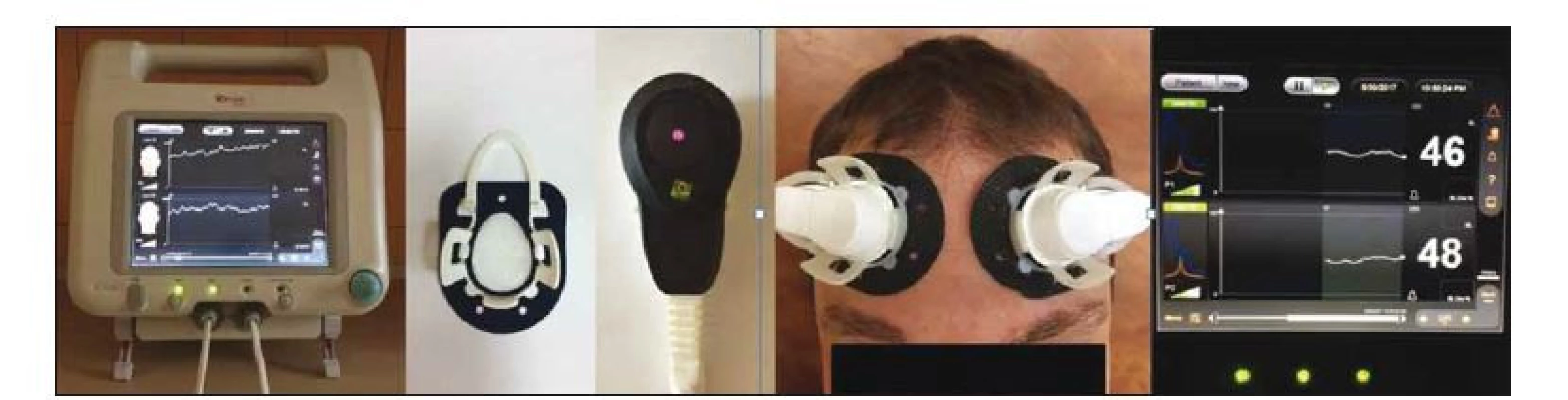 Zariadenie C-FLOW, snímače cerebrálneho prietoku krvi, ich umiestnenie a grafické zobrazenie indexu cerebrálneho prietoku krvi.<br>
Fig. 2. C-FLOW device, blood flow sensors, their placement and a display of the cerebral flow index.