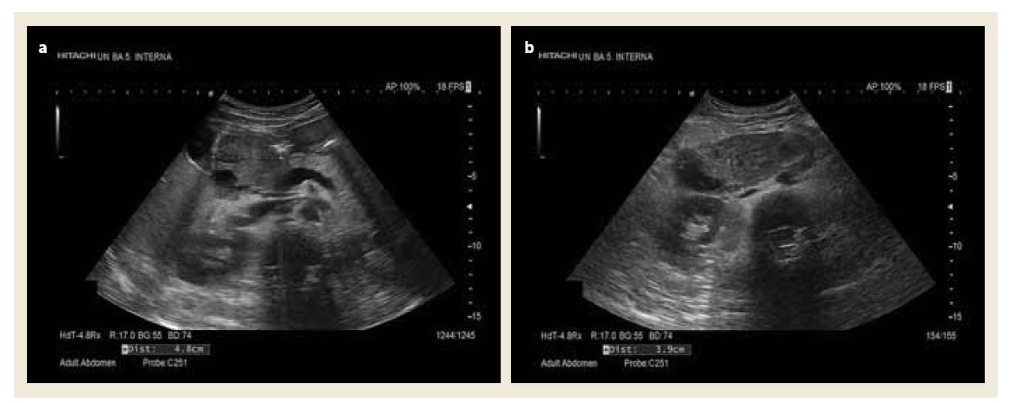 USG obraz spontánneho intramurálneho hematómu duodena.<br>
a) Priečny prierez.<br>
b) Šikmý prierez.<br>
Fig. 1. Ultrasound scan of a spontaneous intramural duodenal hematoma.<br>
a) Transverse section.<br>
b) Oblique section.