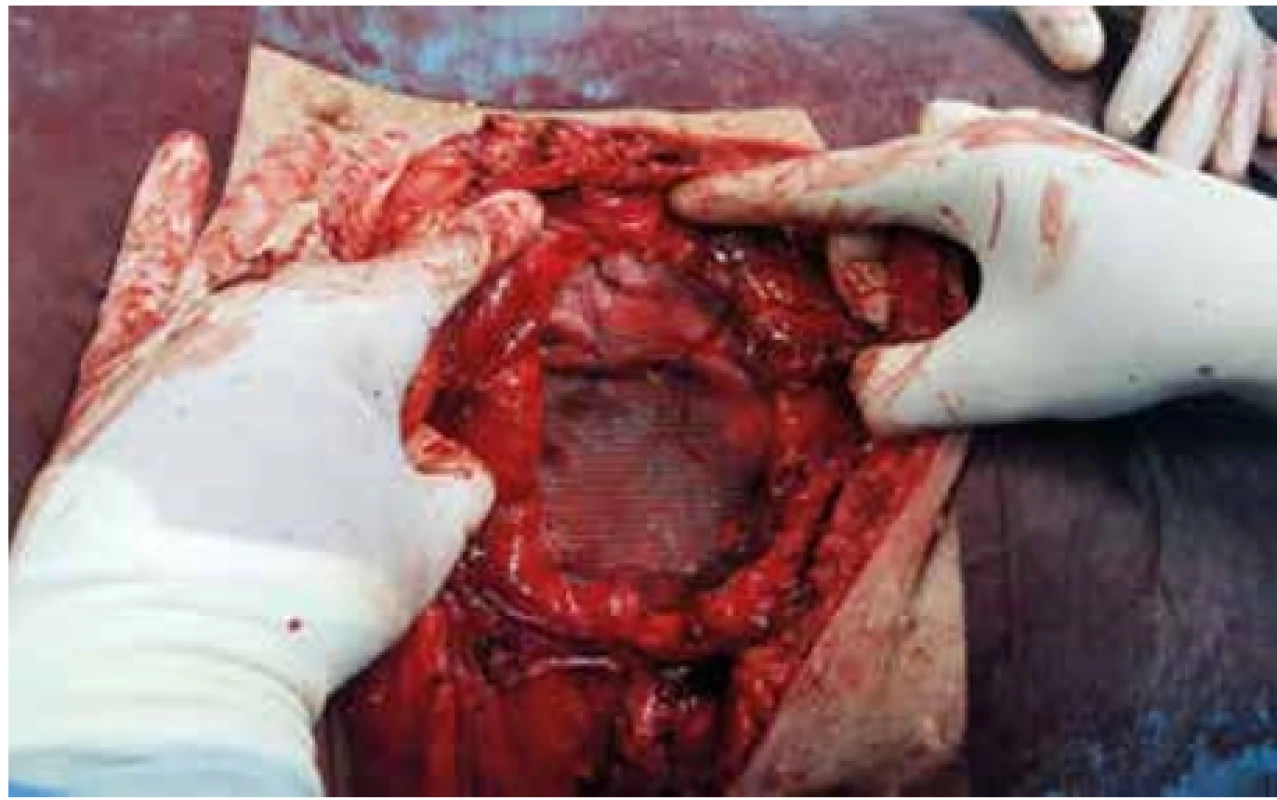 Hernioplastika s použitím síťky <br>
Fig. 4. Hernioplasty with the use of a mesh
