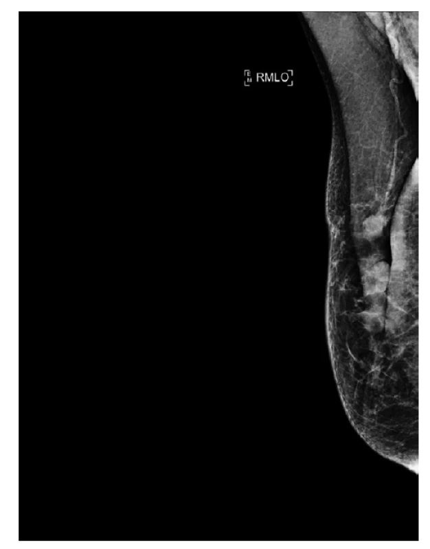 Mamograf, pooperační deformace prsu, vtažení
mamily, nejasná změna v horní části jizvy, zachycená
část axily bez jednoznačné lymfadenopatie.<br>
Fig. 8: Mammogram, postoperative deformity of the breast,
retraction of the nipple, unclear change in the upper
part of the scar, shown part of the axilla without clear
lymphadenopathy.