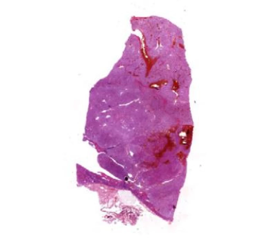 Stejný jako obrázek 5, ale zvětšení 40x; zdroj:
Šiklův patologický ústav FN Plzeň<br>
Fig. 6. The same as Figure 5, but with a magnification
of 40x; source: Šikl Institute of Pathology, Pilsen
University Hospital