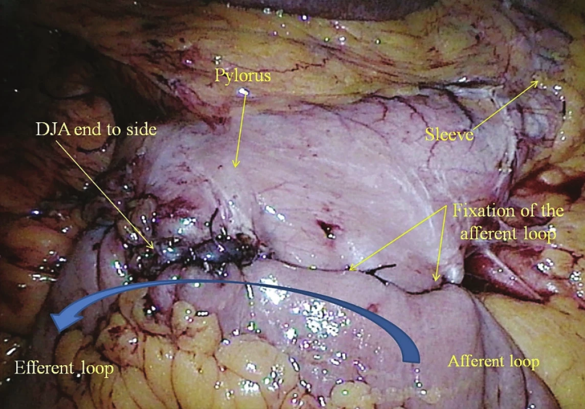 Ručně šitá duodeno-ileální anastomóza<br>
Fig. 4: Hand-sewn duodeno-ileal anastomosis