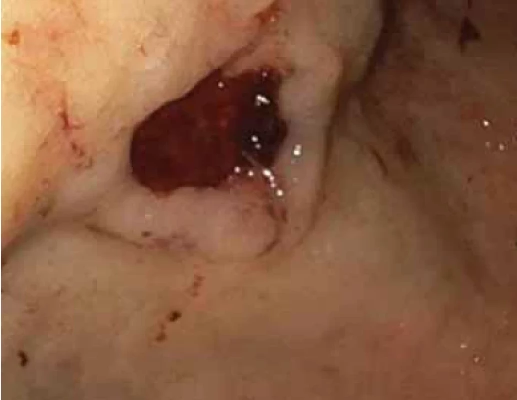 Vředová léze na přední stěně na přechodu těla a antra žaludku– první vyšetření.</br> Fig. 1. Ulcer lesion on the front wall at the junction of the body and antrum of the stomach – the first examination.