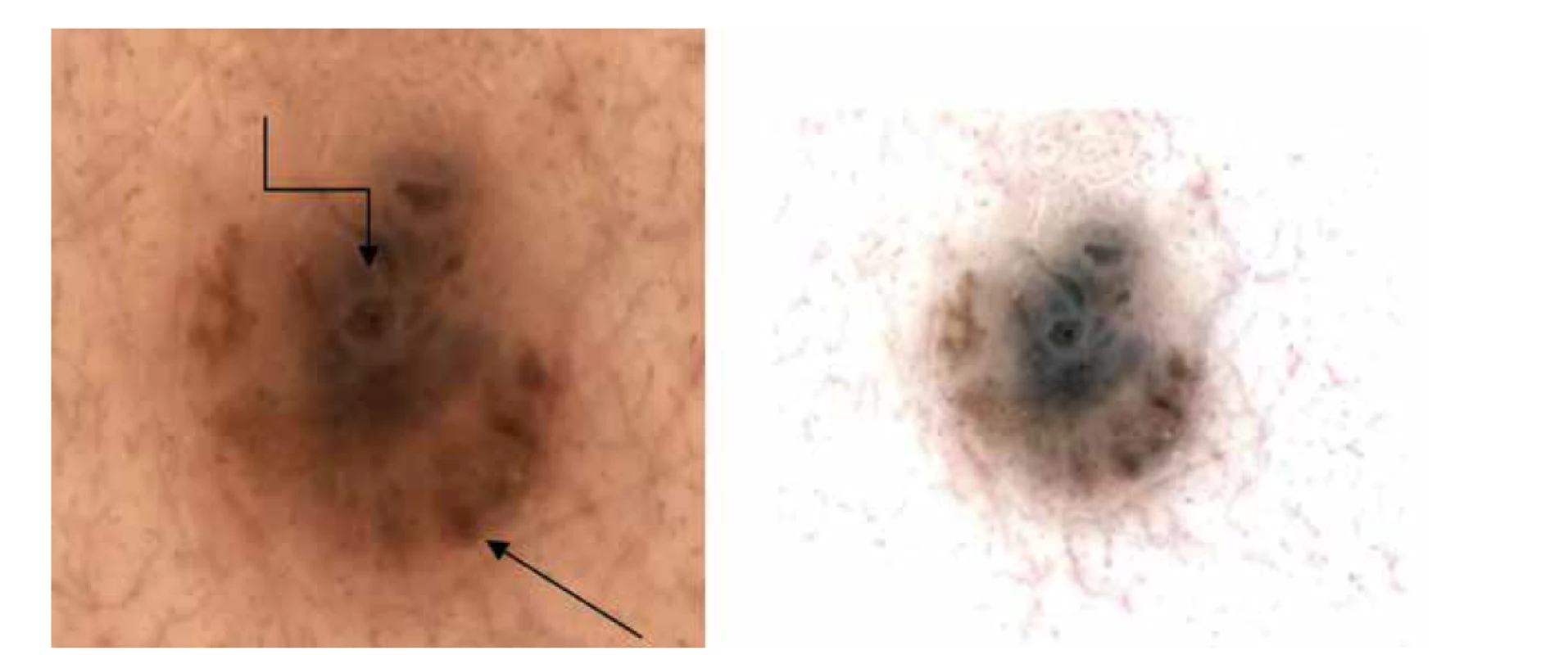 a,b. Dermatoskopicky nepravidelně rozložené robustní globule nestejné velikosti na periferii (šipka), šedavé
zastření zejména střední a horní části (lomená šipka).