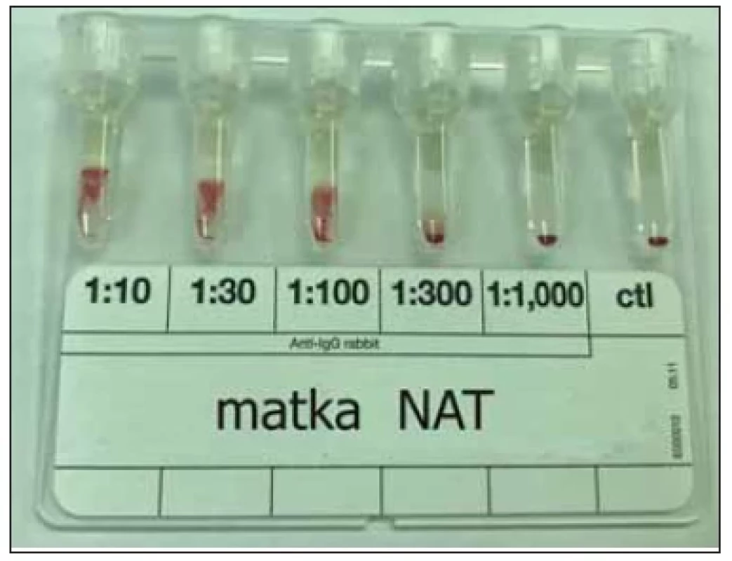 Kvantifi kace IgG protilátky v plazmě matky
(DAT IgG-Dilution BioRad, CCw–Kk).