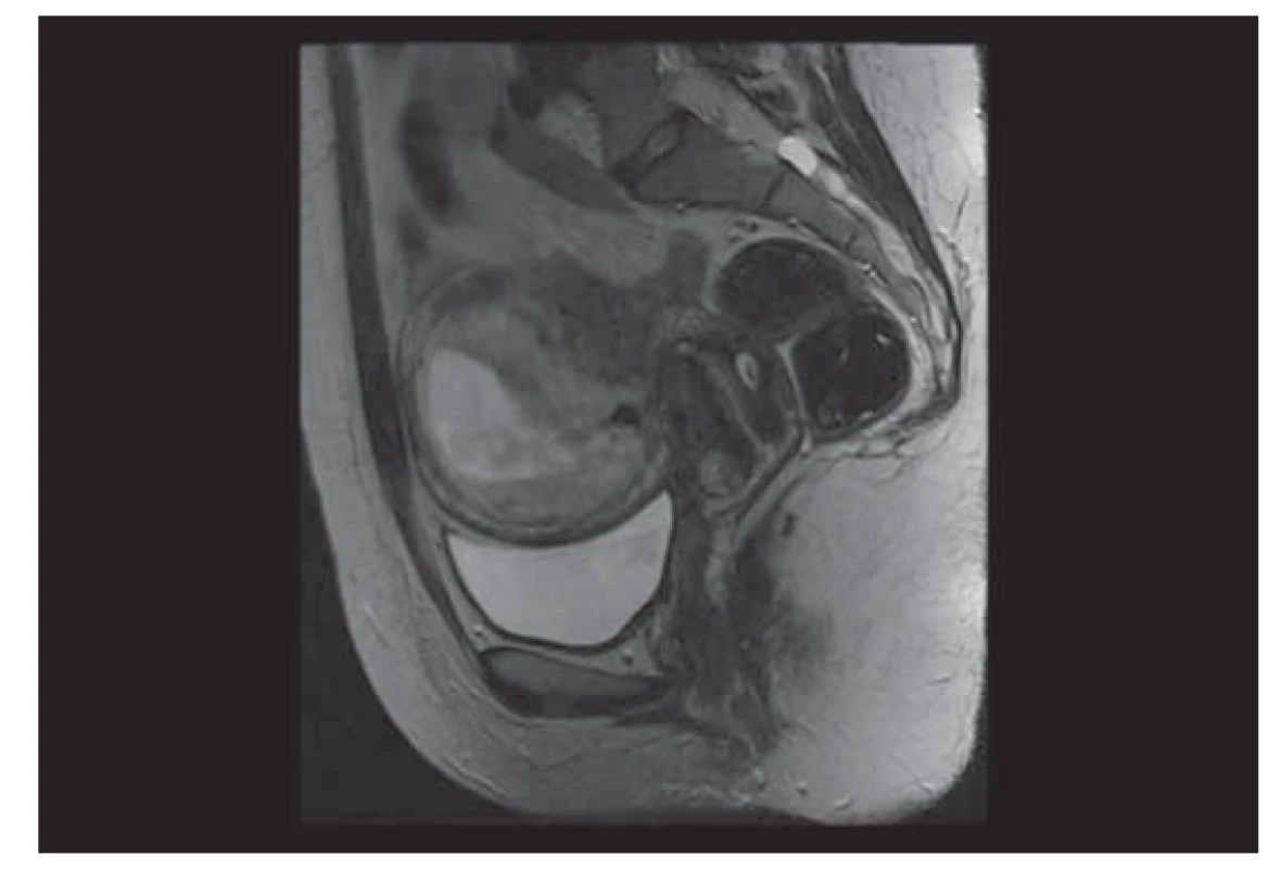 Pánevní magnetická rezonance pacientky s intrauterinní
graviditou.<br>
Fig. 1. Pelvic magnetic resonance of a patient with intrauterine
pregnancy.