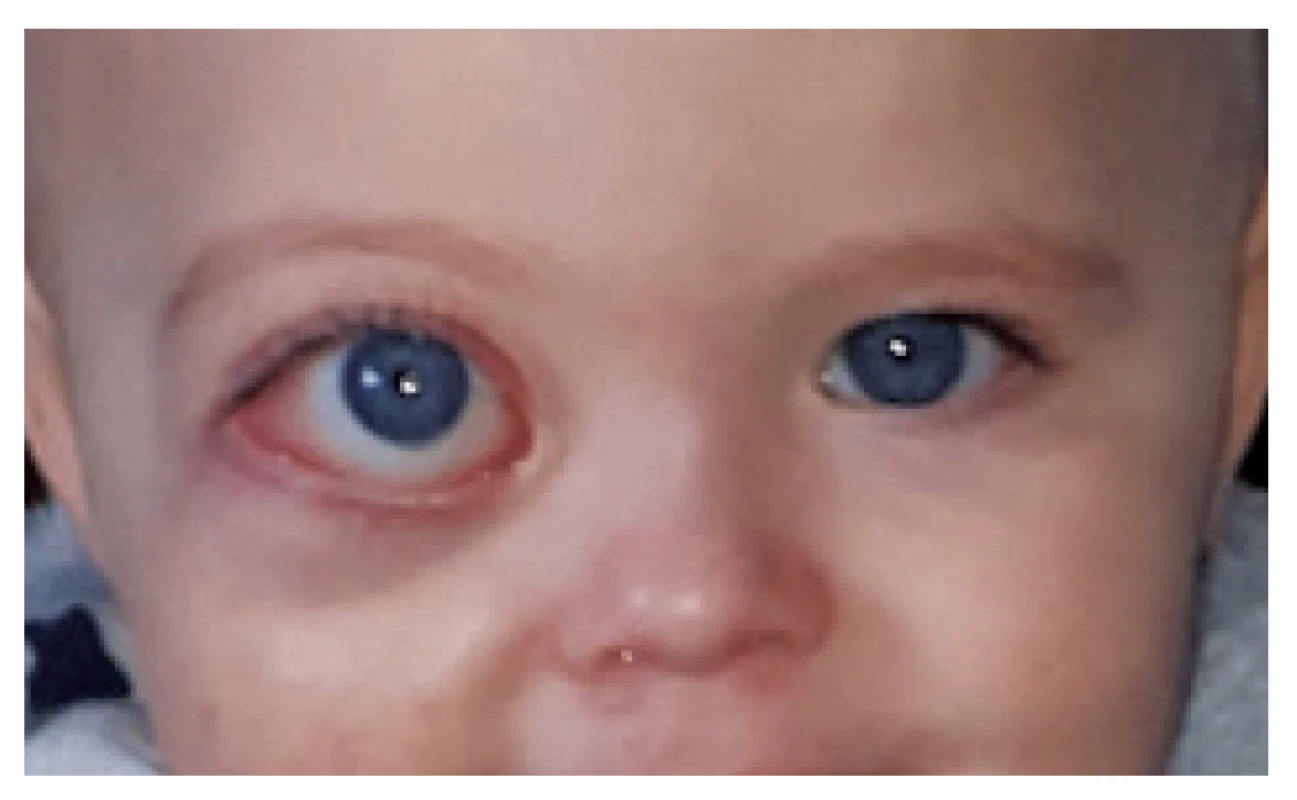 Proptosis of right eyeball with facial asymmetry.
Photograph obtained at the age of 14 months