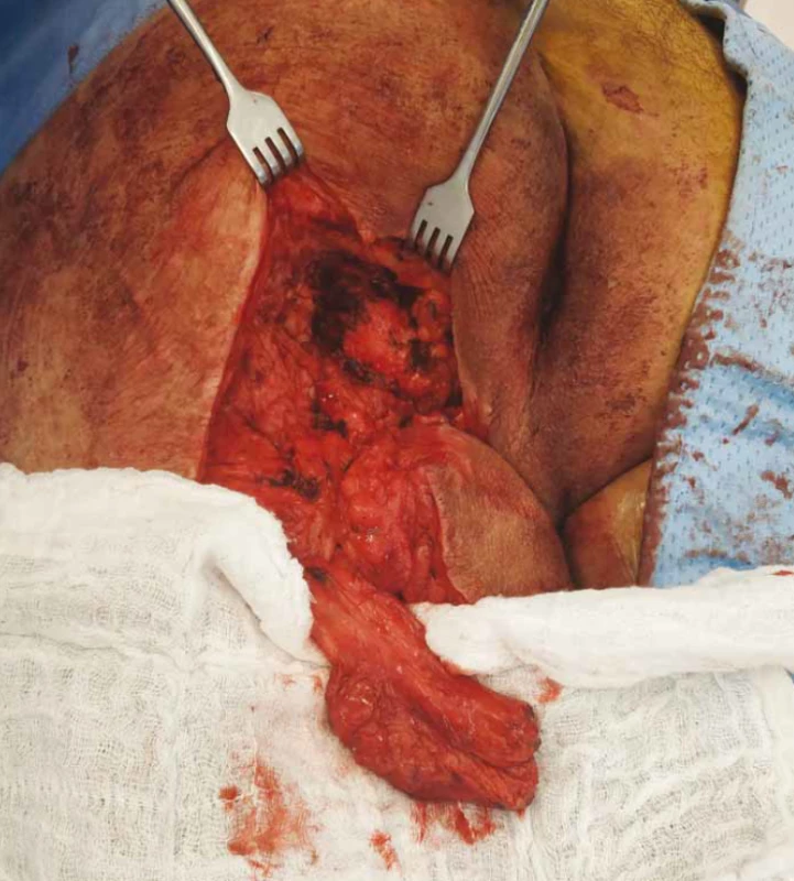 Biceps femoris muscle after dissection.<br>
Obr. 1. Musculus biceps femoris po disekci.