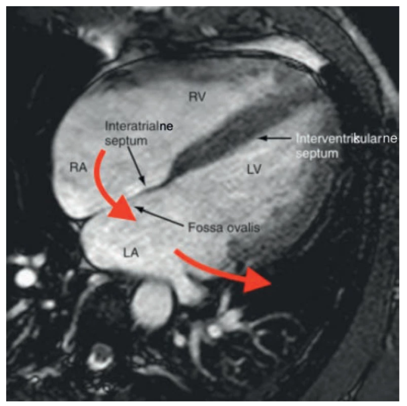 Hypotetická cesta migrácie katétra z pravej predsiene
cez ľavú predsieň<br>
Fig. 5. Hypothetical route of migration of the catheter
from right to left atrium