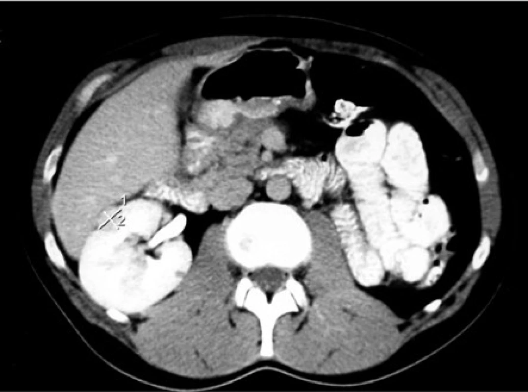 CT, transverzální řez. Muž, 37 let, VHL syndrom. 18mm tumor předního rtu solitární ledviny. V roce 2006 provedena laparoskopicky asistovaná radiofrekvenční ablace. Před tím opakované výkony
na ledvinách pro ccRCC (transperitoneální nefrektomie vlevo, 2x resekce pravé ledviny, exstirpace metastázy ccRCC z levého retroperitonea). Stav po inguinální orchiektomii vlevo pro papilární cystadenom nadvarlete a stav po exstirpaci hemangioblastomu mozečku<br>
Fig. 1. CT scan, transverse plane. Thirty-seven year old
male with a VHL syndrome. 18mm tumor in the ventral
portion of the solitary kidney. The laparoscopy-assisted
radiofrequency ablation was performed in 2006. Before
that, multiple kidney surgeries were done because of
the ccRCC (left transperitoneal nephrectomy, 2x partial
nephrectomy of the right kidney, extirpation of the metastasis of the ccRCC from left retroperitoneum). Status
post left inguinal orchiectomy (papillary cystadenoma
of the epididymis). Status post extirpation of the hemangioblastoma of the cerebellum