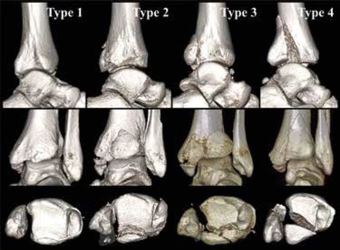 Klasifikace zlomenin malleolus posterior podle Bartoníčka-
-Rammelta
Horní řádek – pohled do incisura fibularis tibiae po subtrakci distální fibuly,
střední řádek – pohled z dorzální strany, dolní řádek – pohled do tibiofibulární
vidlice po subtrakci talu. Typ 1 – extraincisurální, Typ 2 – posterolaterální,
Typ 3 – dvoufragmentový, zasahující do mediálního kotníku; Typ 4
– velký triangulární, nesoucí dorzální polovinu incisura fibularis tibiae.<br>
Fig. 5. Classification of posterior malleolus fractures according to Bartoníček
and Rammelt
Top line – view of the fibular notch after subtraction of the distal fibula;
middle line – posterior view; bottom line – view into the tibiofibular mortise
after subtraction of the talus. Type 1 – extraincisural; Type 2 – posterolateral;
Type 3 – a two-part fragment involving the medial malleolus; Type 4
– a large triangular fragment bearing the posterior half of the fibular notch.