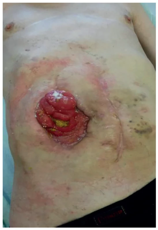 Ileostomie s enterokutánní píštělí<br>
Fig. 3: Ileostomy with enterocutaneous fistula