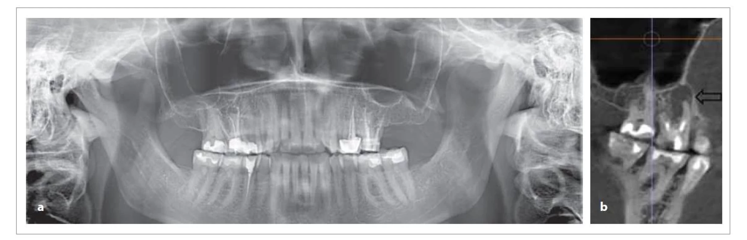 Srovnání OPG a CBCT u téhož pacienta, možnost diagnostiky periapikální patologie zubu 16 z OPG snímku je
velmi omezená a snadno přehlédnutelná, zatímco z CBCT vyšetření je nález zcela jednoznačný (a – OPG, b – CBCT).<br>
Fig. 1. Comparison of OPG and CBCT in the same patient, the possibility of diagnosing periapical lesion of tooth 16 from the
OPG is very limited and easily overlooked, while from the CBCT examination the finding is quite clear (a – OPG, b – CBCT).