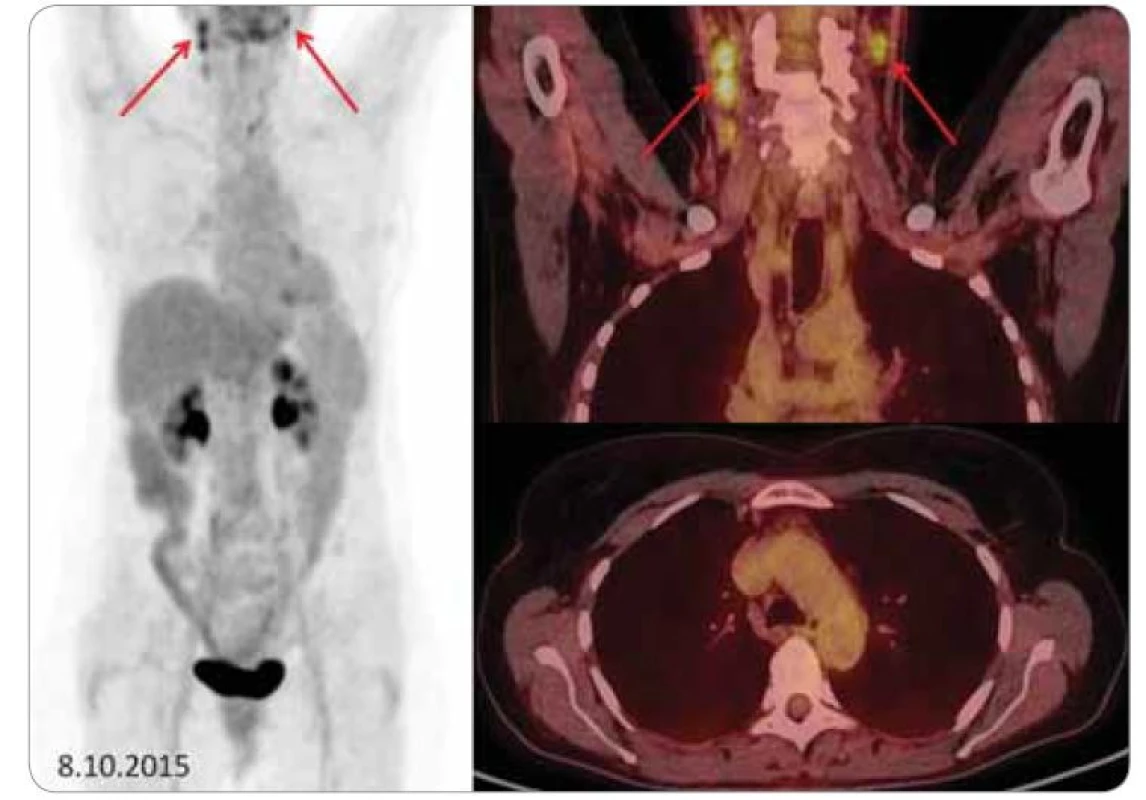 Kontrolní PET CT.