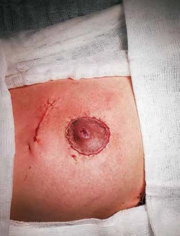 Pooperační výsledek po resekci prsu <br>
Fig. 3: Postoperative outcome of breast resection