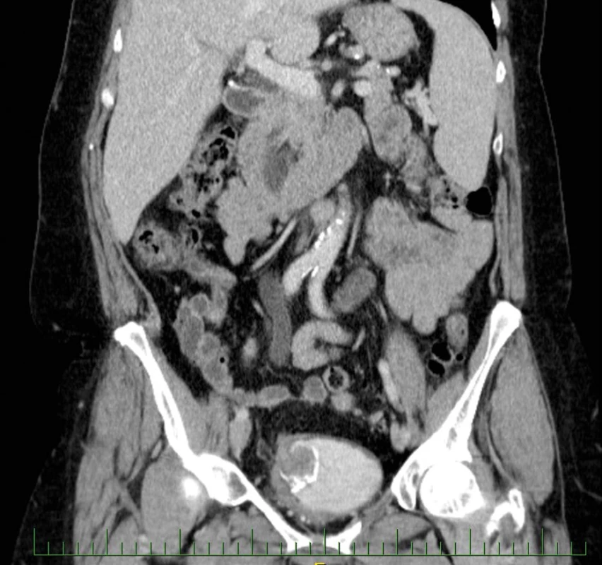 CT vyšetření zachycující intraluminální expanzi v augmentovaném močovém měchýři<br>
Fig. 1. CT examination capturing intraluminal expansion in the augmented bladder