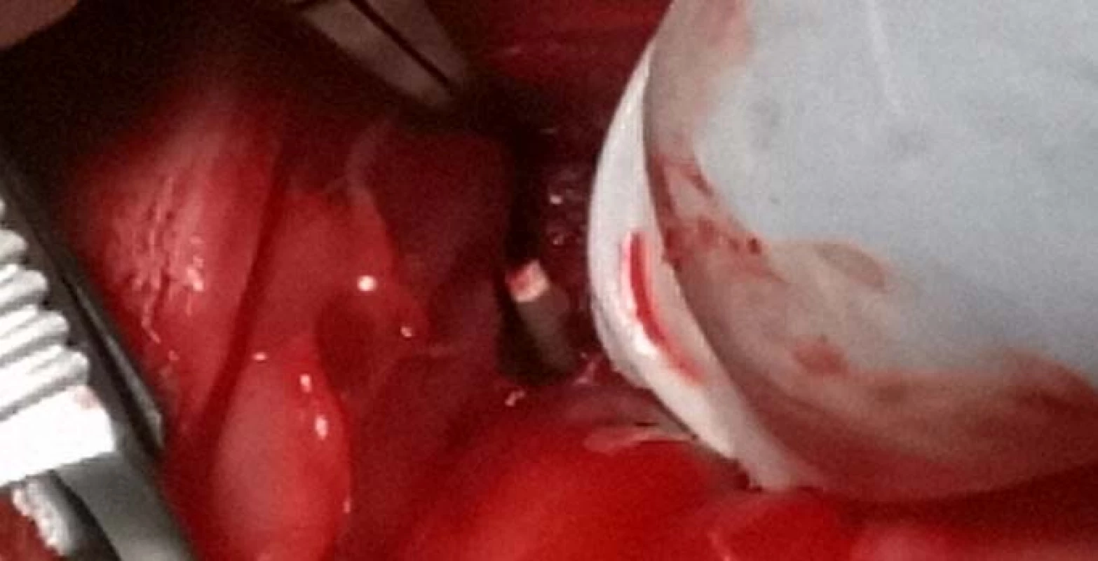 Inserting the filament into a bone defect.