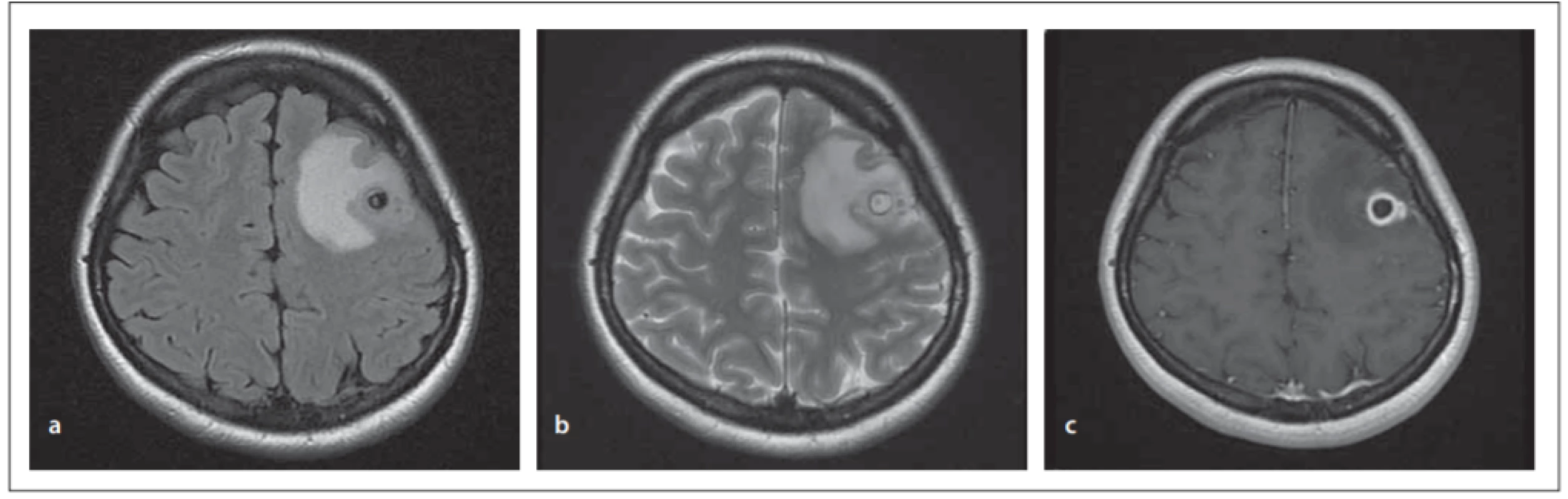 MRI of the brain, transverzal images. Cystic ring enhancing lesion in the left frontal region, with distinct perifocal oedema; most likely
a granular nodular stage of neurocysticercosis. (a) T1 weighted image; (b) T2 weighted image; (c) T1 weighted image with gadolinium.<br>
Obr. 2. MR mozku, transverzální řezy. Cystické ložisko frontálně vlevo s enhancujícím prstencem, s výrazným perifokálním edémem. Nejspíše granulárně nodulární stadium neurocystercerkózy. (a) T1 vážený snímek; (b) T2 vážený snímek; (c) T1 vážený snímek s gadoliniem.