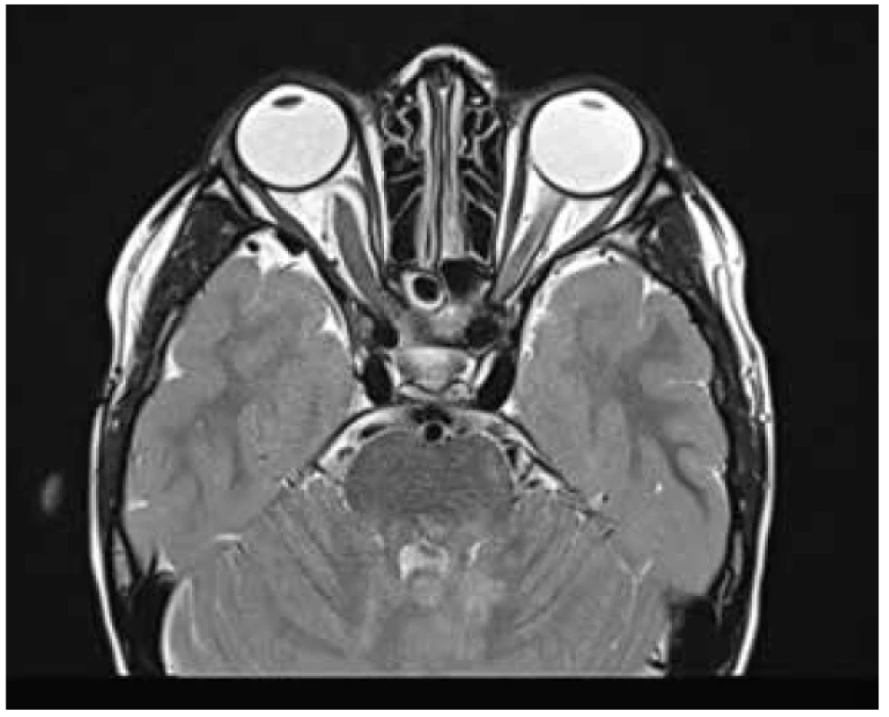 MR T2 TSE sek. trans. sken gliomu optiku s mírnou
protruzí pravého bulbu. <br>
Zdroj: Klinika dětské radiologie
LF MU a FN Brno