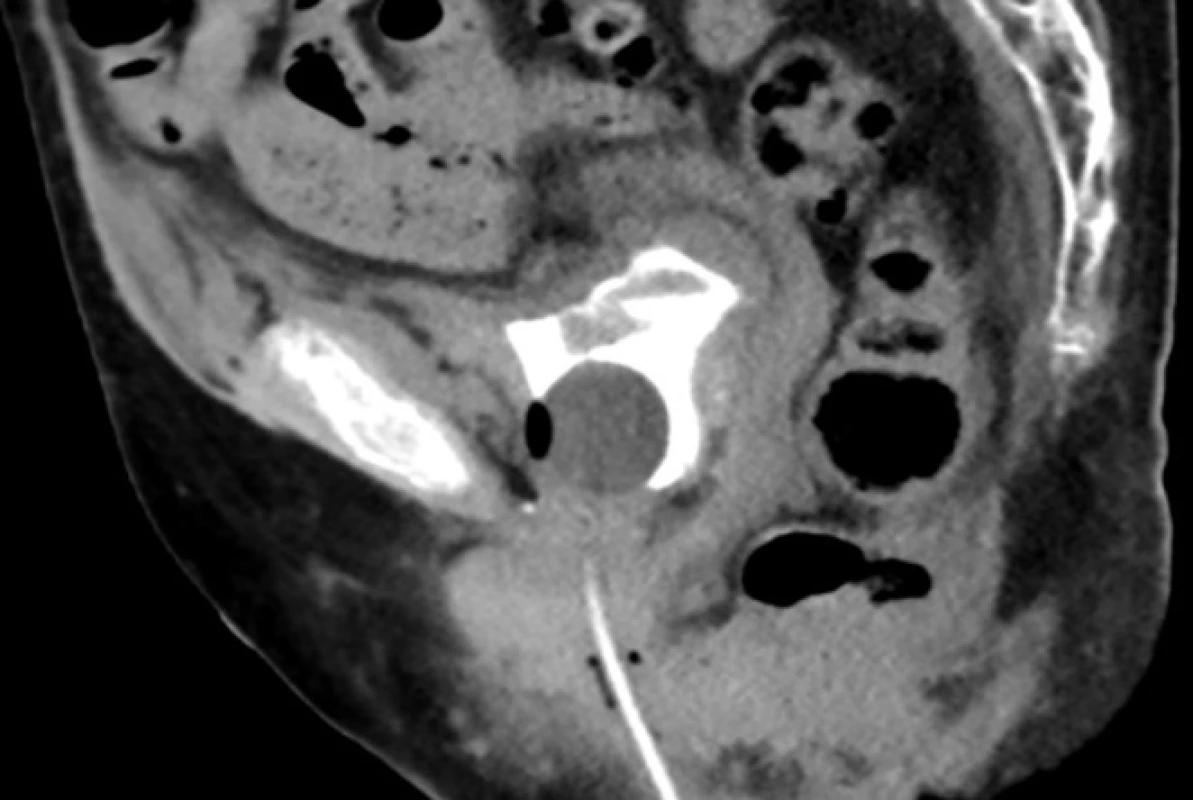 CT cystografie sagitální
řez, močový měchýř při
menší náplni bez úniku kontrastní
látky<br>
Fig. 2. CT cystogram sagittal
view. Partial filling of the urinary
bladder with no contrast
leak demonstrated