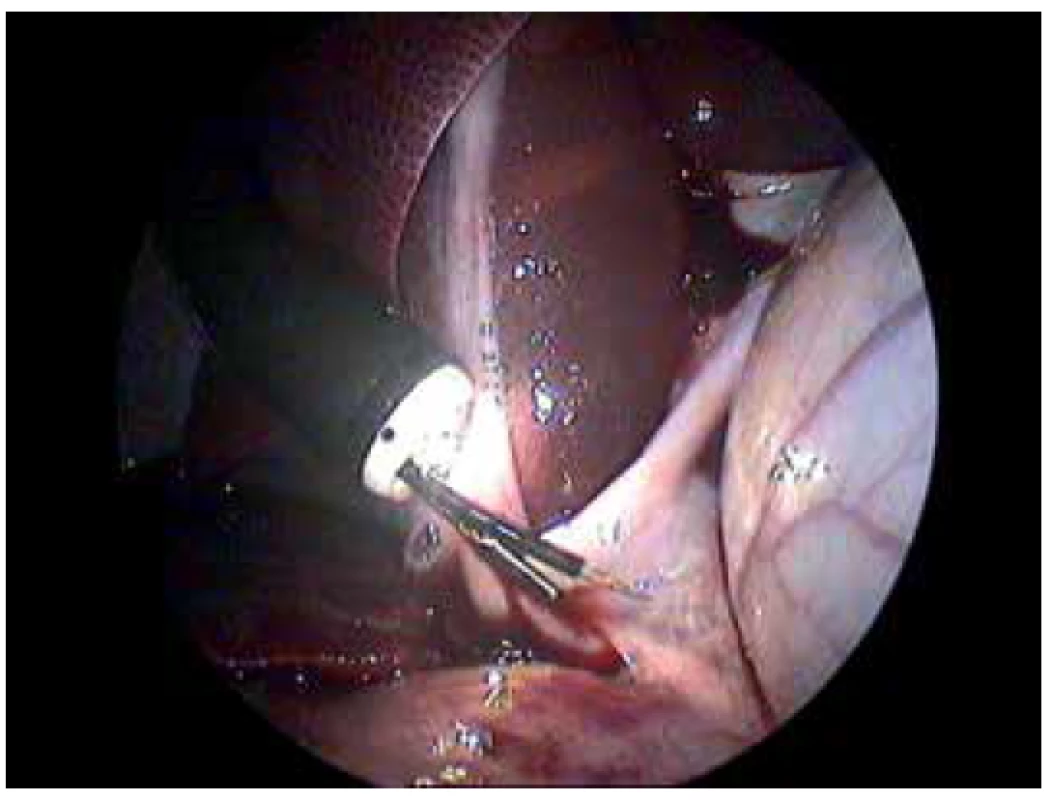 Hybrid NOTES procedure of saline application into the
portal vein<br>
Laparoscopic view of the site of application. In the center of the
view there is the tip of the endoscope with the injector (front
working channel) and grasper (back working channel). Endoscopic
grasper is pulling and fixing tunica adventitia/serosa of
the portal vein. The endoscopic injector is moving closely to the
portal vein.