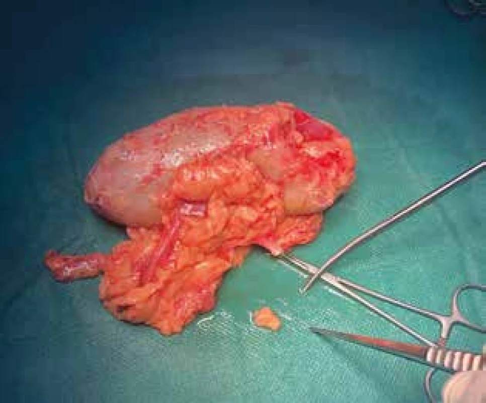 Ledvina od dárce; odběr tukové tkáně<br>
Fig. 1. Living-donor kidney; removal of adipose tissue