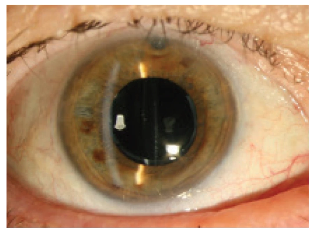 Anterior segment after lavage without capsular
distension, frilled posterior capsule