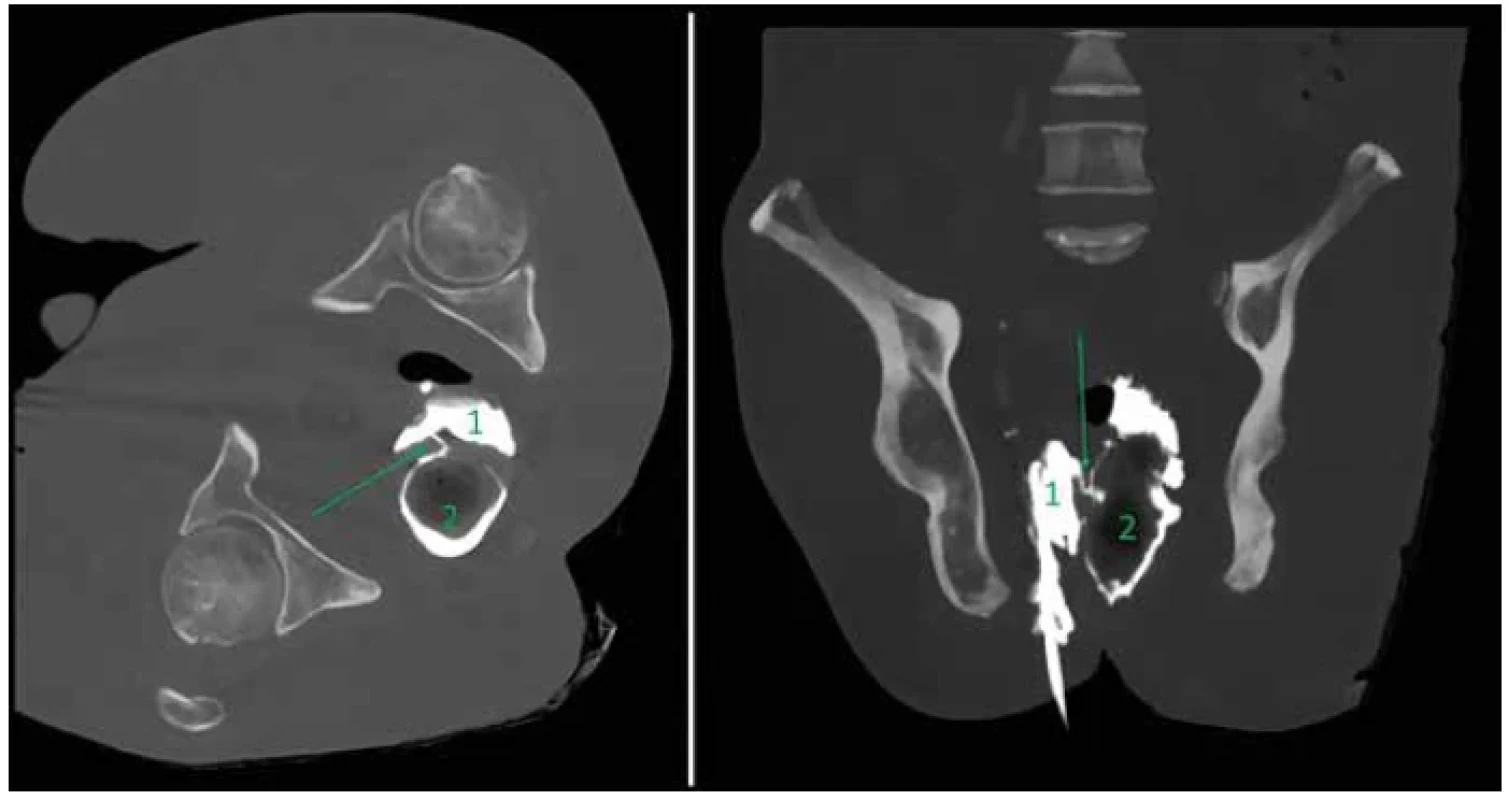 CT scan of pelvis with contrast revealing the fistula (marked with a green arrow) between the perirectal abscess (1)
and rectum (2) <br> 
Axial plane – left, coronal plane – right.