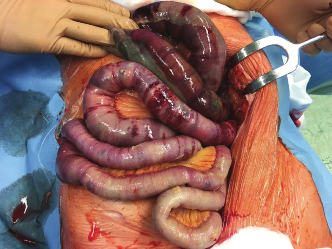 Akutní zhoršení chronické mezenteriální ischemie<br>
Fig. 2: Acute deterioration of chronic mesenteric ischemia