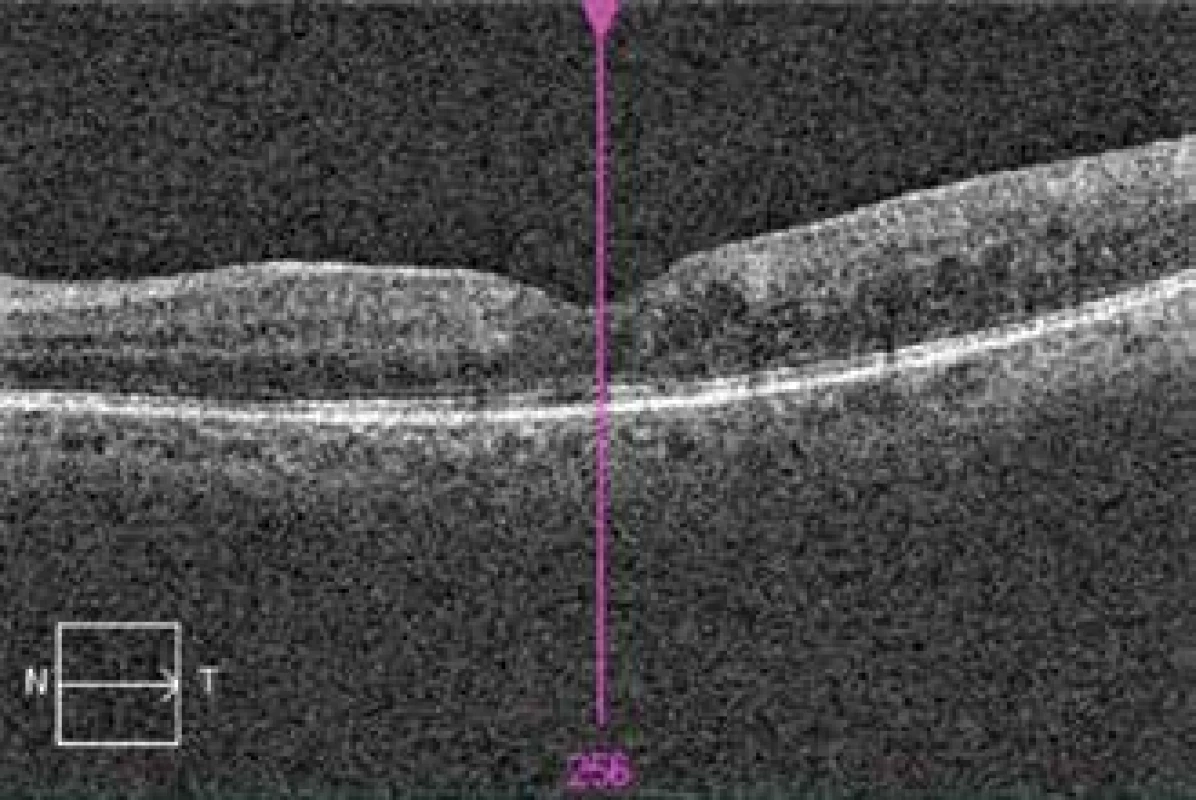 OCT of left eye 8 weeks after commencement of
therapy, created foveal depression, without lesion pathology