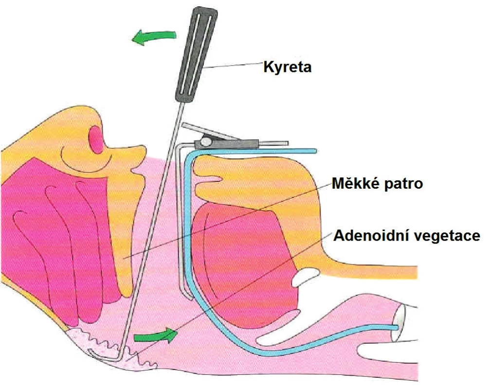 Adenotomie (upraveno dle http://sites.google.com).