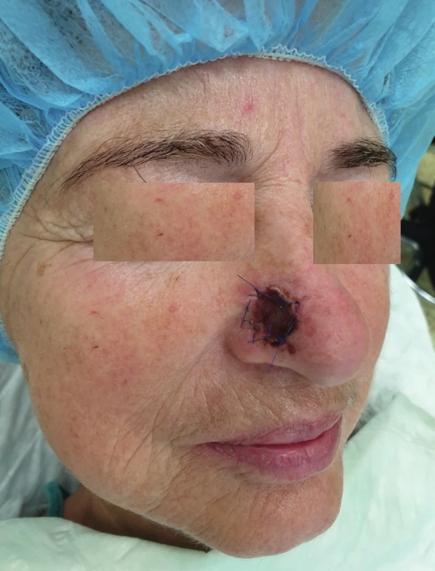 Condition after a radical excision of a malignant lesion on an ala nasi (author’s archive)