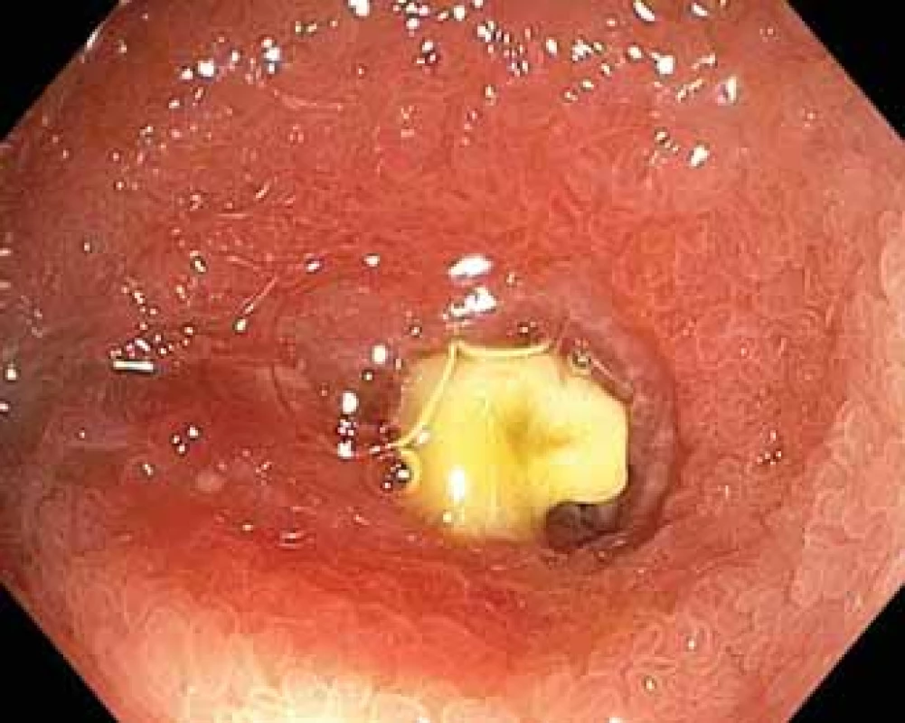 NSA-indukovaná stenóza ilea.
Fig. 6. NSAID-induced stricture of the ileum.